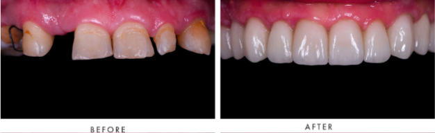 Full Mouth Dental Implants Transformation