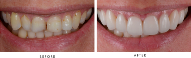 Porcelain Veneers Transformation