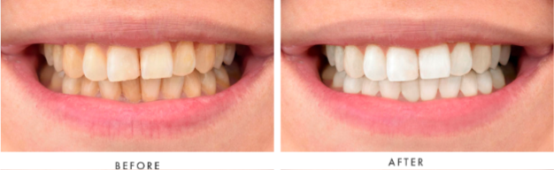 Teeth Whitening Transformation